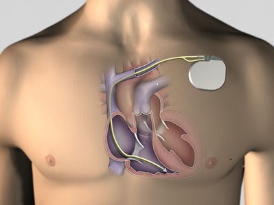 ĐẶT MÁY TẠO NHỊP TẠM THỜI ĐIỀU TRỊ RỐI LOẠN NHỊP CHẬM