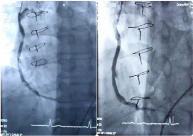Quảng Ninh lần đầu tiên thực hiện thành công can thiệp đặt stent cầu nối tĩnh mạch hiển