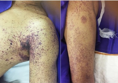 Cảnh báo nguy cơ nhiễm liên cầu khuẩn lợn khi ăn tiết canh