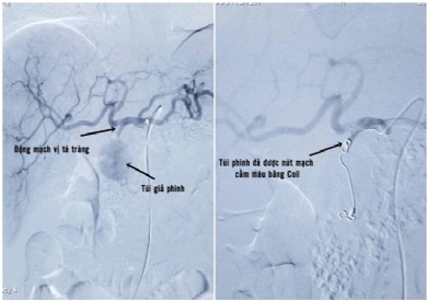 Nút mạch cấp cứu bệnh nhân nguy kịch do ổ giả phình động mạch vị tá tràng