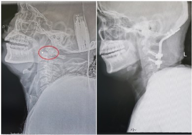 Cứu thành công ca tai nạn mất vận động tứ chi hiếm gặp bằng kỹ thuật cố định cột sống cổ vào xương chẩm