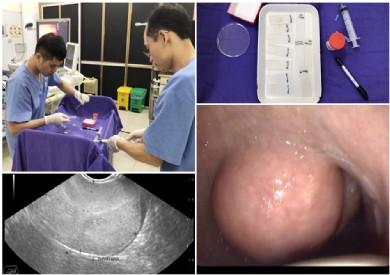 Triển khai chọc hút tế bào dưới hướng dẫn siêu âm nội soi: Cơ hội phát hiện sớm ung thư đường tiêu hóa