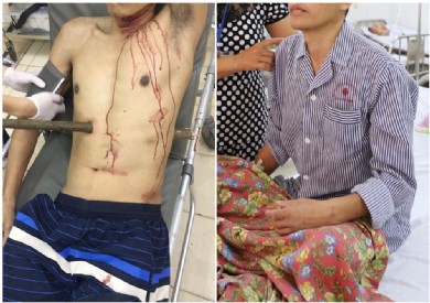 Bệnh nhân bị cọc gỗ xuyên thấu người phục hồi tốt và chuẩn bị ra viện