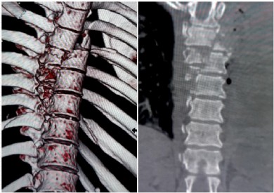 Ca phẫu thuật khó cứu bệnh nhân gãy trật đốt sống ngực phức tạp