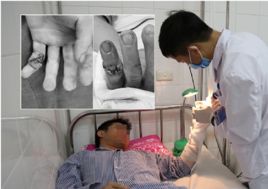 Bệnh viện Đa khoa tỉnh vi phẫu nối thành công đốt ngón tay bị đứt lìa