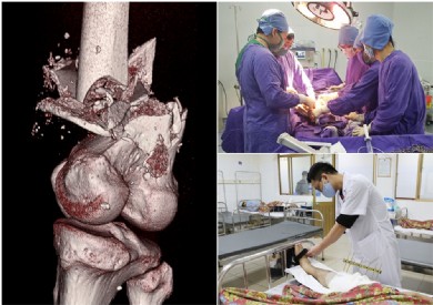 Nam bệnh nhân thoát khỏi nguy cơ cắt cụt chi nhờ phẫu thuật nối chân thành công