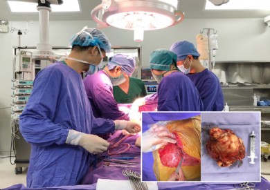 Bệnh viện Đa khoa tỉnh phẫu thuật lấy thành công khối u trung thất “khổng lồ” nằm đè tim