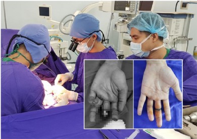Bệnh viện Đa khoa tỉnh Quảng Ninh làm chủ kỹ thuật vi phẫu nối chi thể đứt rời phức tạp