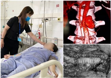 Phẫu thuật cấp cứu bệnh nhân thủng động mạch chủ bụng nguy kịch do lao