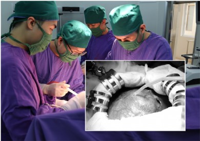 Phẫu thuật nang đường mật ''khổng lồ'' cho sản phụ người dân tộc thiểu số