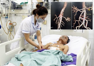 Phẫu thuật thành công bắc cầu động mạch mạc treo tràng trên cho bệnh nhân suy tim nặng