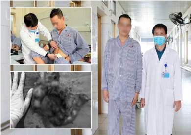 Uống thuốc nam không rõ nguồn gốc, u ác sau phúc mạc to nhanh và xâm lấn phức tạp