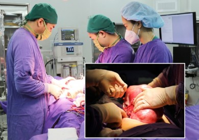 Phẫu thuật cắt u tử cung to như bụng bầu 6 tháng cho nữ bệnh nhân 50 tuổi
