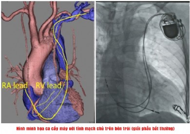 Đặt máy tạo nhịp vĩnh viễn cho cụ ông 90 tuổi có giải phẫu mạch máu bất thường hiếm gặp
