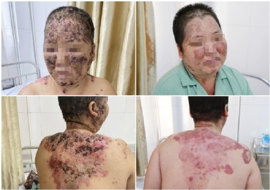 Người phụ nữ mắc bệnh da bọng nước tự miễn bị bội nhiễm nguy hiểm do tắm lá