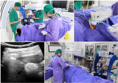Ưu việt của kỹ thuật đốt sóng cao tần RFA trong điều trị ung thư gan