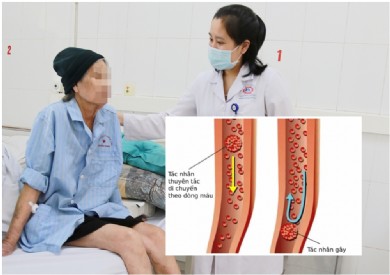 Nỗ lực phòng ngừa thuyên tắc huyết khối tĩnh mạch sâu tại Bệnh viện Đa khoa tỉnh Quảng Ninh