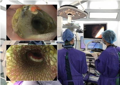 Đặt stent thực quản nâng cao chất lượng cuộc sống cho người bệnh ung thư giai đoạn cuối