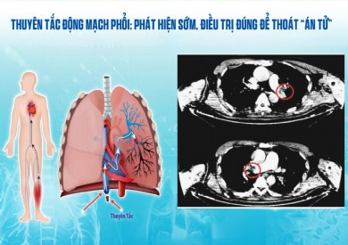 Thuyên tắc động mạch phổi: Phát hiện sớm, điều trị đúng để thoát “án tử”