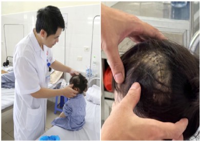 Phẫu thuật cứu bé 3 tuổi bị tụ máu não sau ngã: Cảnh báo tai nạn sinh hoạt ở trẻ nhỏ!